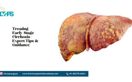 Treating Early-Stage Cirrhosis | Expert Tips & Guidance