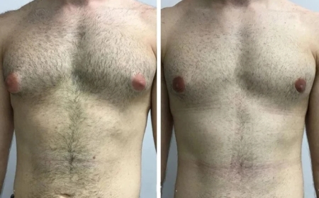 Comparing the Best Gynecomastia Surgeons in Dubai: A Detailed Guide