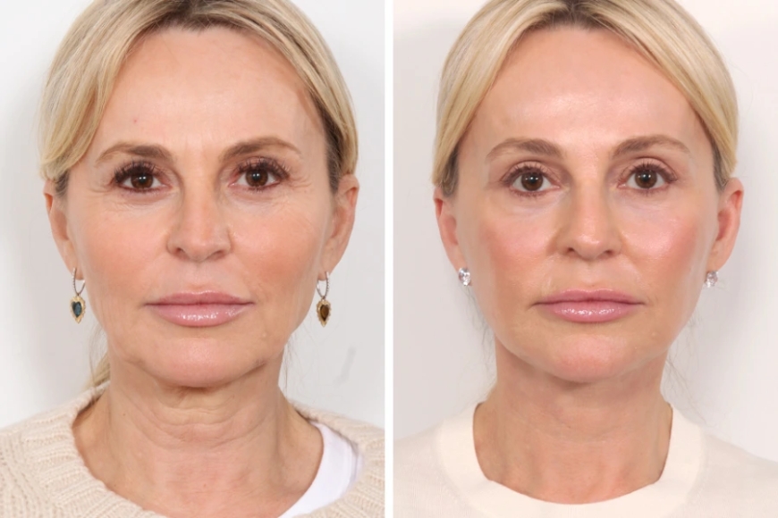 Thread Lift Aftercare: Tips from the Best Plastic Surgeon in Dubai