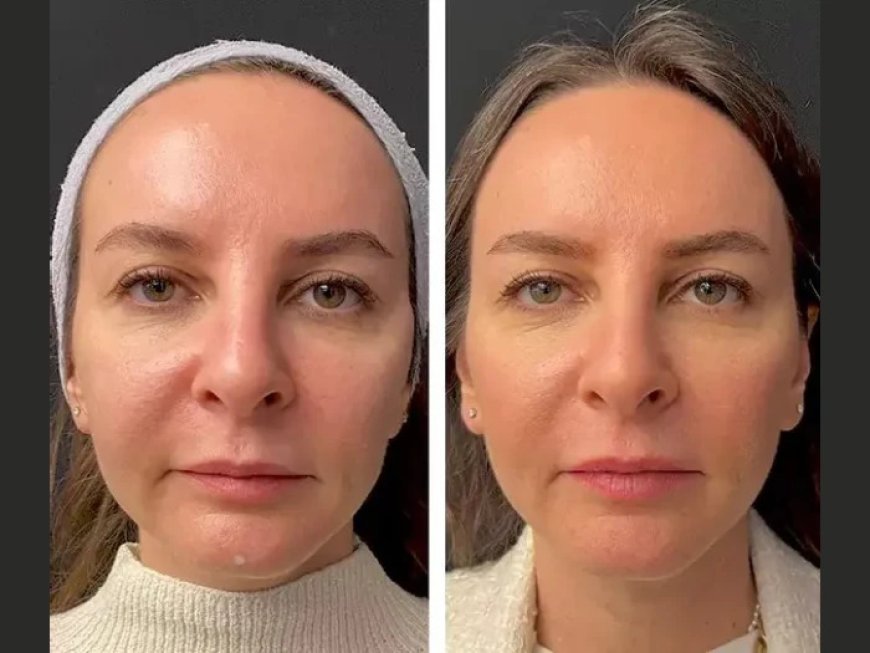 Mesotherapy for Double Chin: What the Best Plastic Surgeon in Dubai Can Do