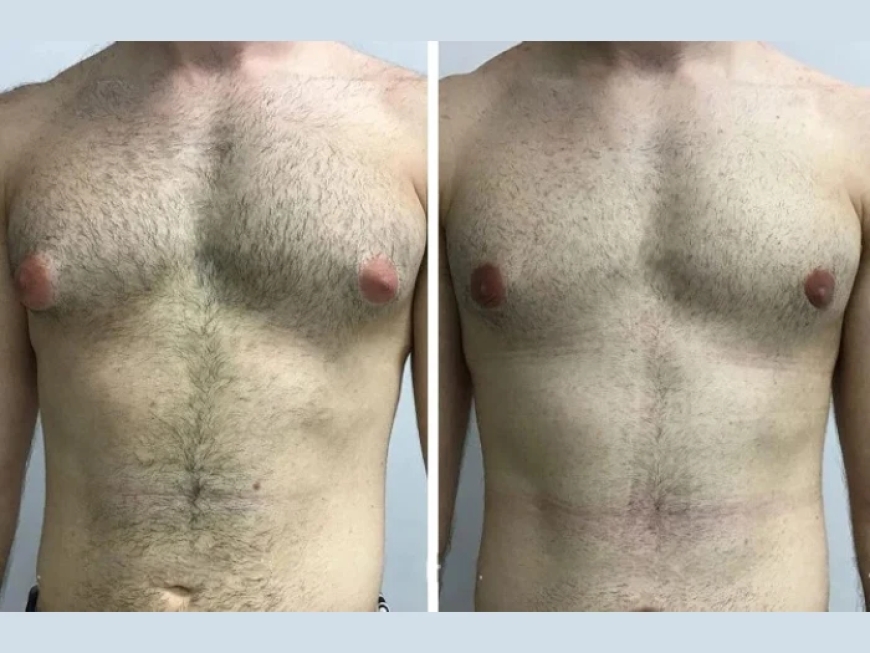 Gynecomastia in Dubai: How to Identify the Right Time for Treatment