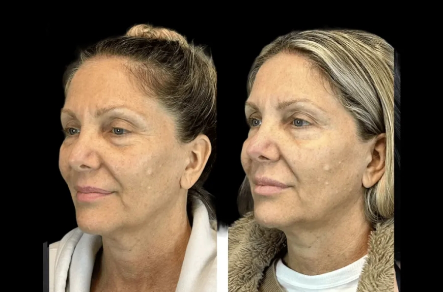 From Consultation to Confidence: A Day at the Best Aesthetic Clinic in Dubai