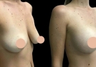Your Perfect Fit: Meet the Best Breast Augmentation Surgeon in Dubai