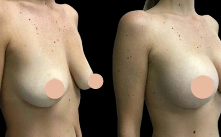 Your Perfect Fit: Meet the Best Breast Augmentation Surgeon in Dubai