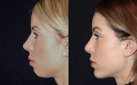 Chin Fillers in Dubai: A Safe and Effective Treatment for Chin Definition