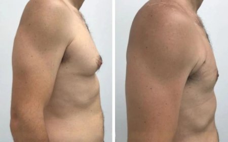 The Ultimate Guide to Finding the Best Gynecomastia Surgeons in dubai