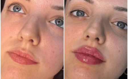How Juvederm Helps Fight Aging: Insights from the Best Plastic Surgeon in Dubai