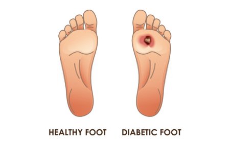 Challenges and Opportunities in the Diabetic Foot Ulcer Market
