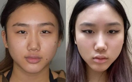 Buccal Fat Removal and the Golden Ratio: Best Doctors in Dubai Discuss Facial Aesthetics