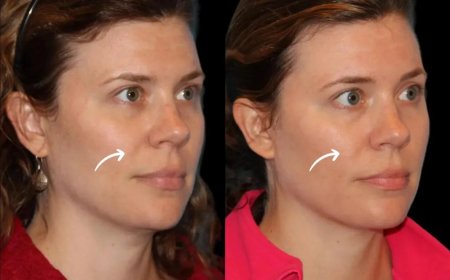 Nanotech advancements in Sculptra fillers: Best Aesthetic Clinics in Dubai approach