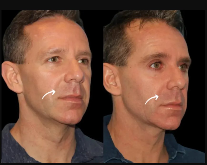 Expert Interview: Lead Physician at Best Aesthetic Clinic in Dubai on Sculptra Fillers