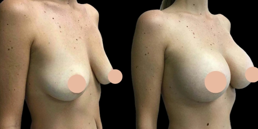 Your Perfect Fit: Meet the Best Breast Augmentation Surgeon in Dubai