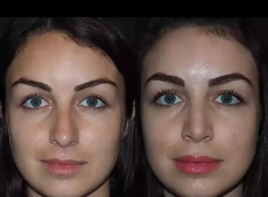 Best Rhinoplasty Surgeon in Dubai Shares Pre-Op and Post-Op Tips
