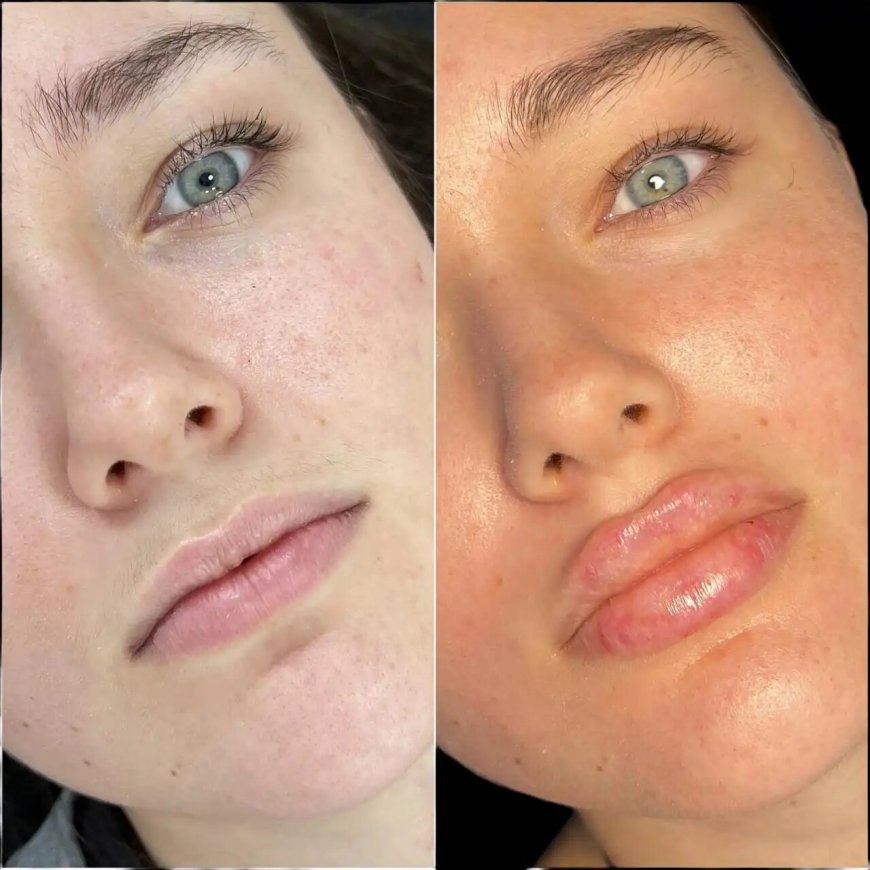 Fillers in Dubai: The Ideal Treatment for Wrinkle Reduction