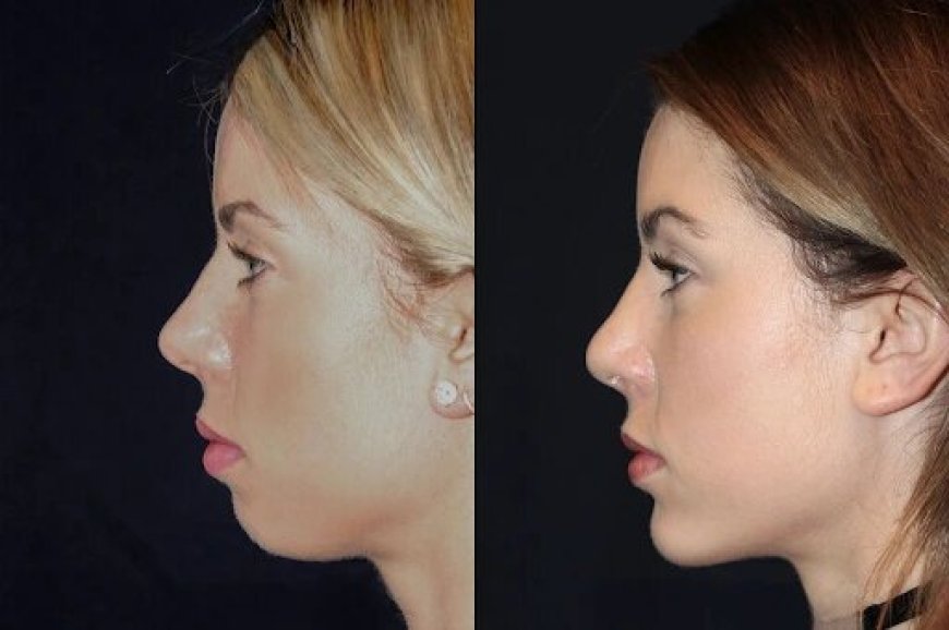 Chin Fillers in Dubai: A Safe and Effective Treatment for Chin Definition