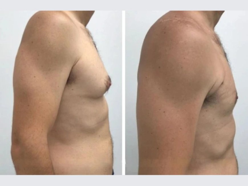 The Ultimate Guide to Finding the Best Gynecomastia Surgeons in dubai
