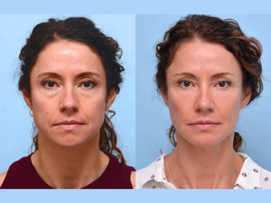 Minimal Downtime, Maximum Results: Thread Lifts by the Best Plastic Surgeons in Dubai