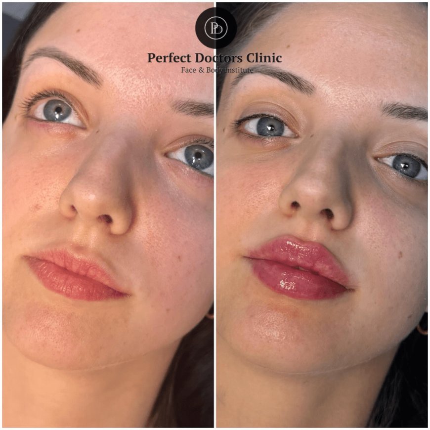 How Juvederm Helps Fight Aging: Insights from the Best Plastic Surgeon in Dubai