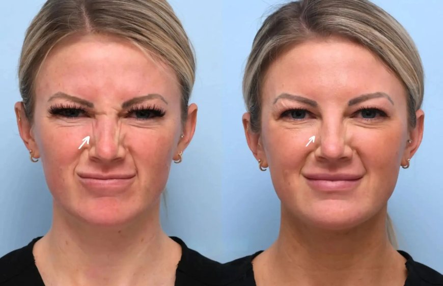 How Botox Treatment in Dubai Can Improve Your Facial Symmetry