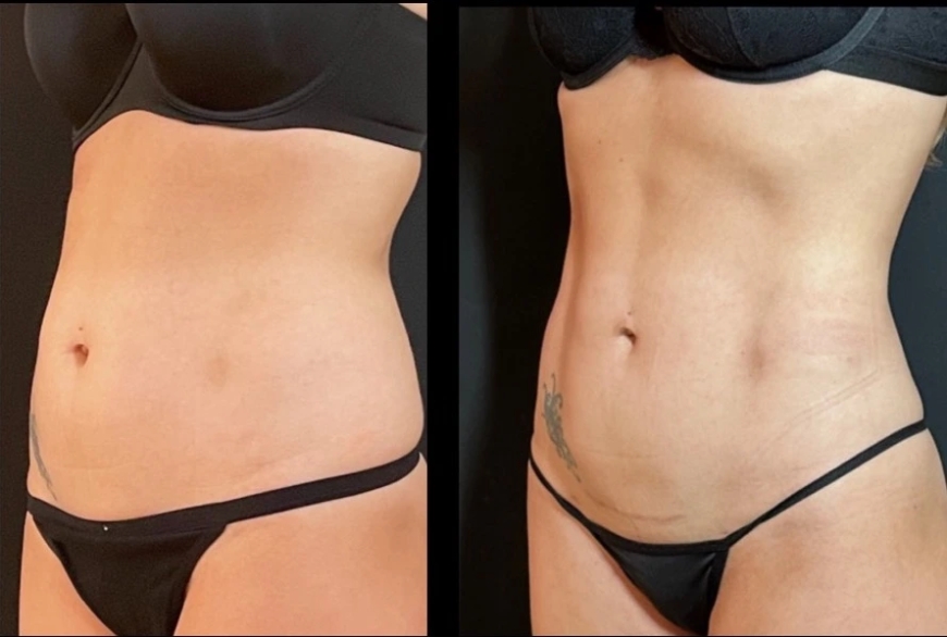 Fat Transfer Surgery in Dubai: Is It the Right Option for You?