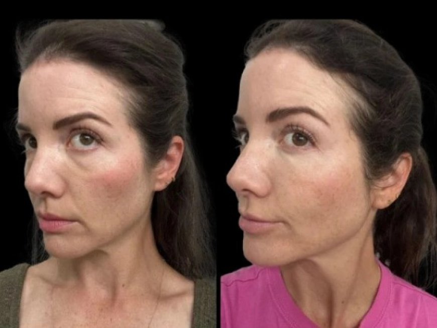 Best Doctors in Dubai for Dark Circles: Non-Surgical Options That Work