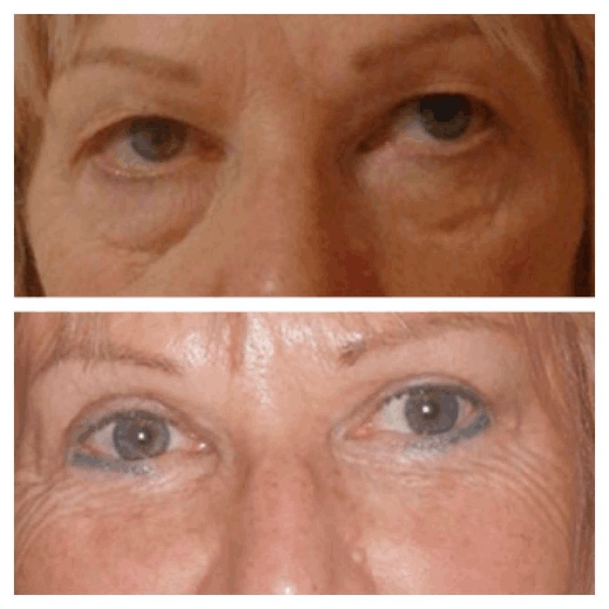 Best Doctors in Dubai on What Makes Eye Bag Removal Results Look Natural