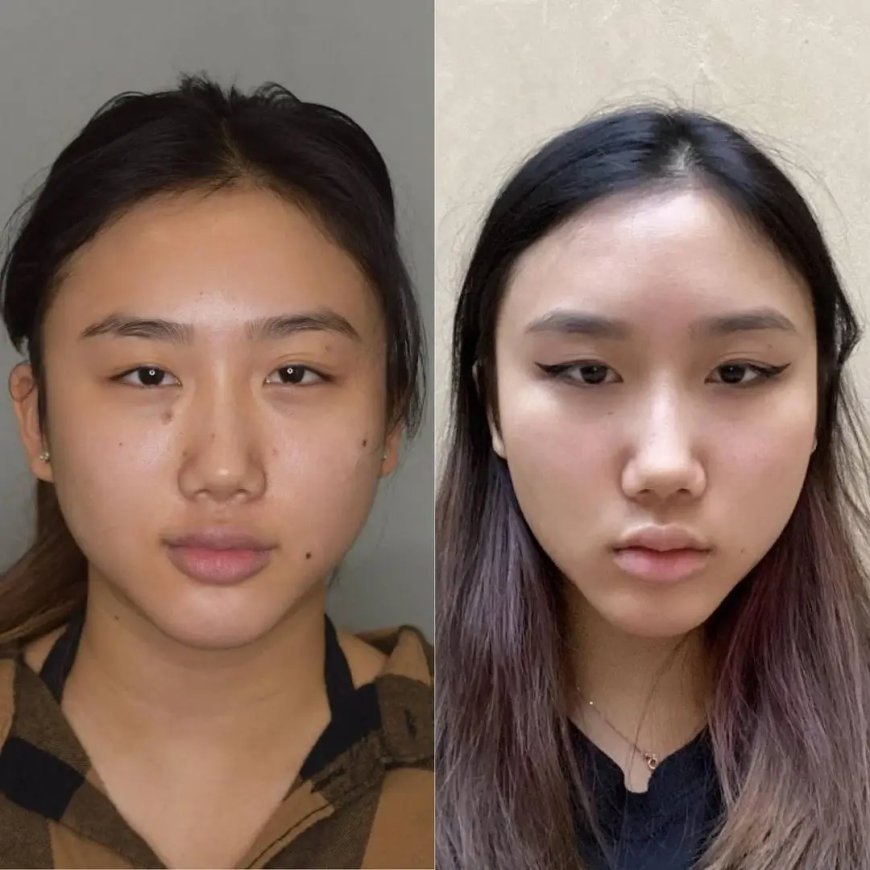 Buccal Fat Removal and the Golden Ratio: Best Doctors in Dubai Discuss Facial Aesthetics