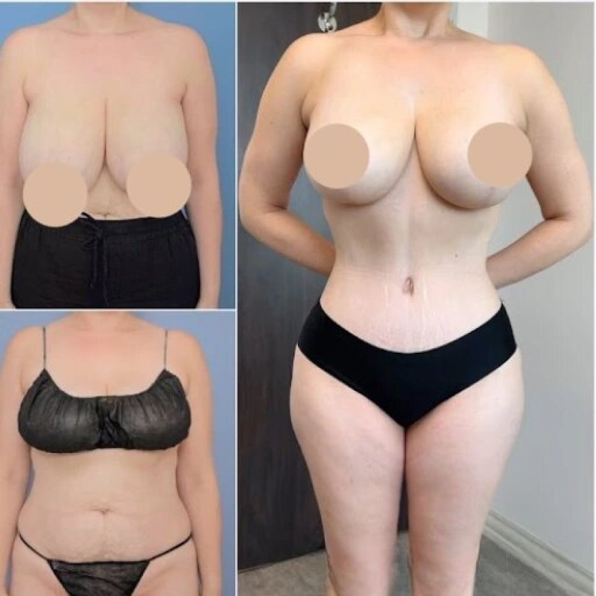 Tummy Tuck in Dubai: Transform Your Abdomen with Expert Surgeons