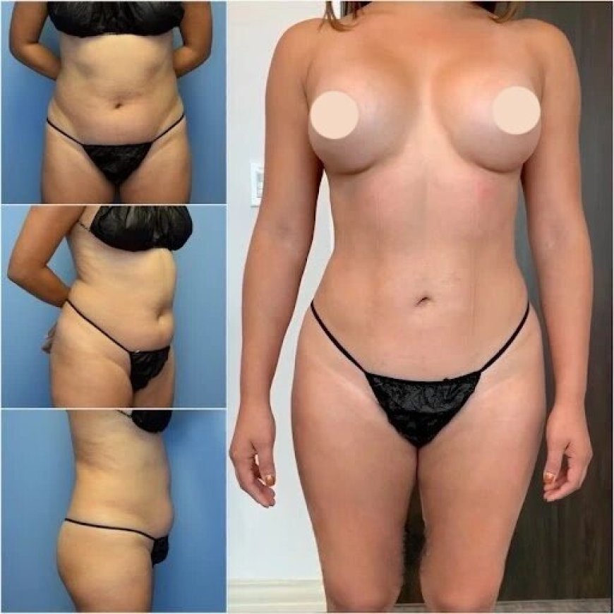 How Body Contouring in Dubai Works for Different Body Types