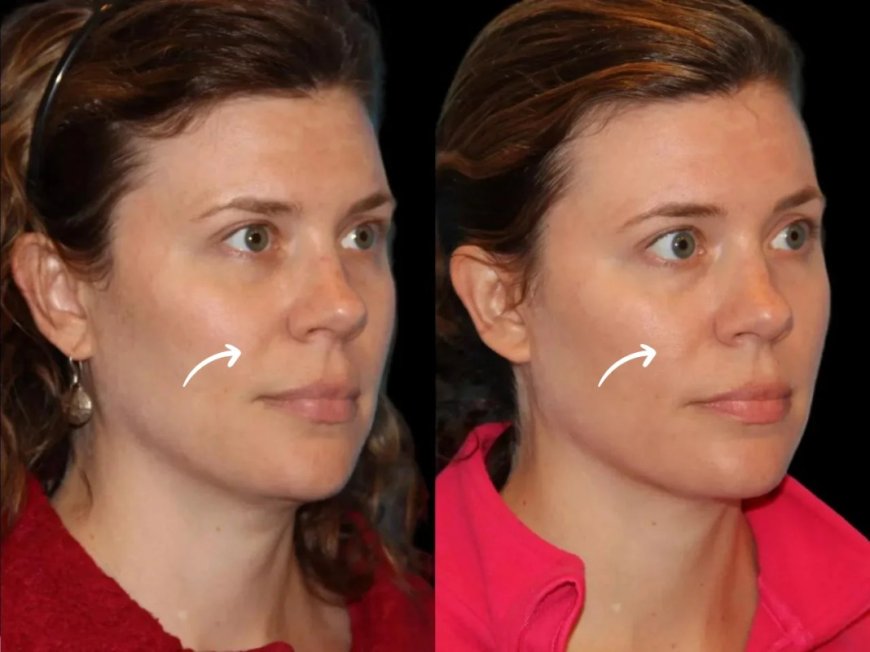 Nanotech advancements in Sculptra fillers: Best Aesthetic Clinics in Dubai approach