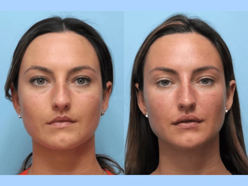 The Rise of Thread Lifts Best Plastic Surgeons in Dubai Revealed