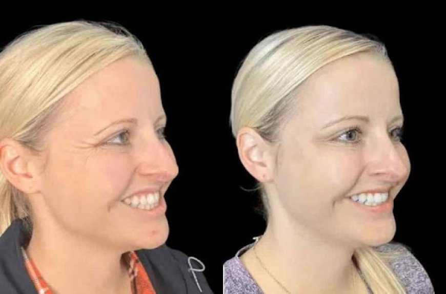 Botox Perfection from the Best Plastic Surgeons in Dubai